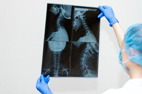 Osteochondrozės stuburo liga