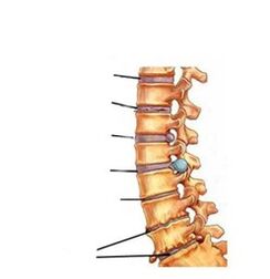 Osteochondrozės vystymosi stadijos