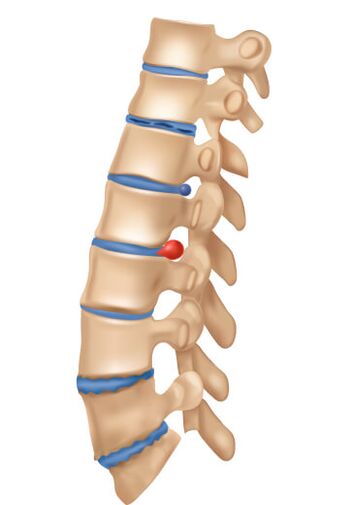 Kaip atrodo deophrming osteochondrozė