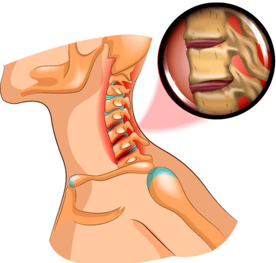 osteochondrozė kakle