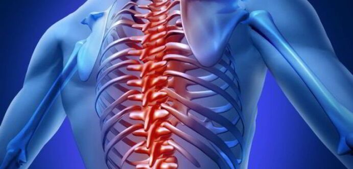 krūtinės ląstos stuburo osteochondrozė